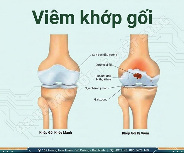 Viêm khớp gối: Đừng đợi đến khi đi lại khó khăn mới chữa!